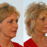 Facelift before and after photos in Houston, TX, Patient 28295