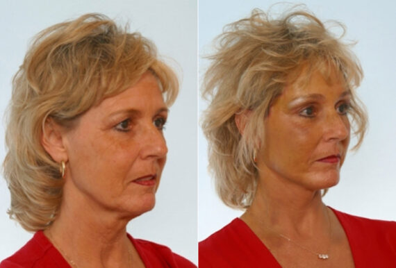 Facelift before and after photos in Houston, TX, Patient 28295