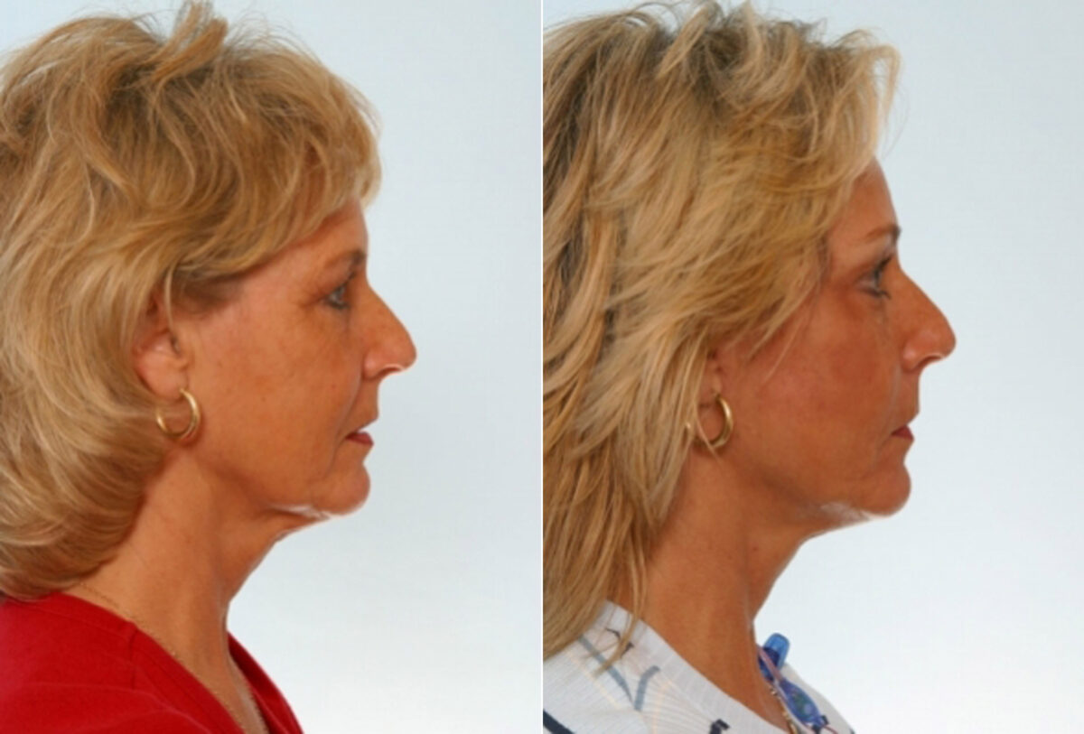 Facelift before and after photos in Houston, TX, Patient 28295