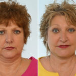 Facelift before and after photos in Houston, TX, Patient 28302