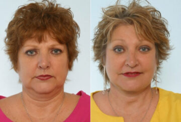 Facelift before and after photos in Houston, TX, Patient 28302