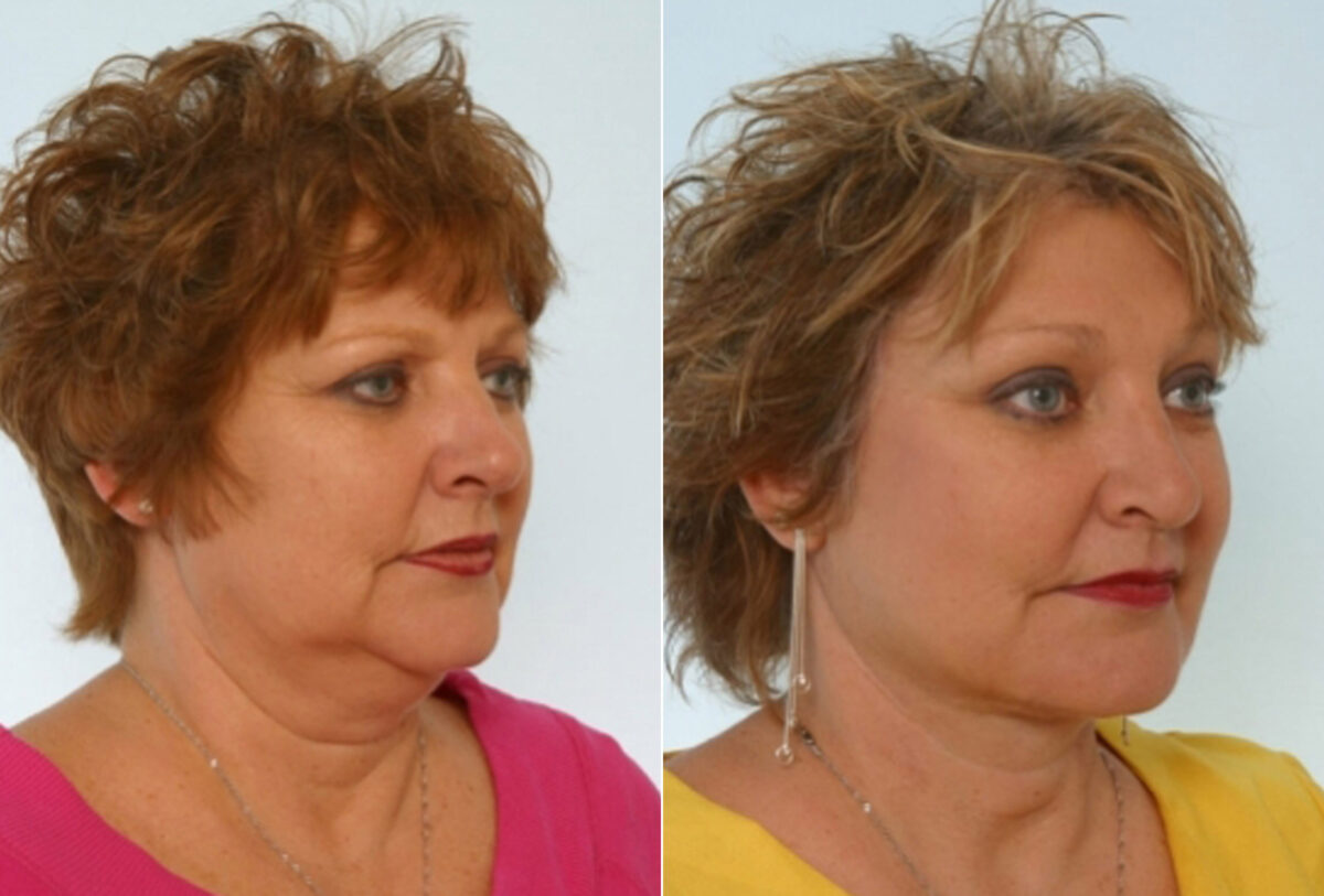 Facelift before and after photos in Houston, TX, Patient 28302