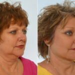 Facelift before and after photos in Houston, TX, Patient 28302