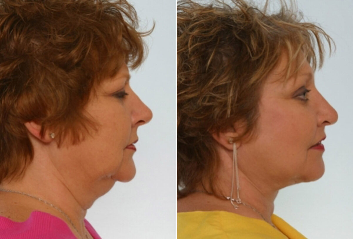 Facelift before and after photos in Houston, TX, Patient 28302