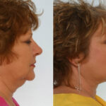 Facelift before and after photos in Houston, TX, Patient 28302