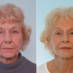 Facelift before and after photos in Houston, TX, Patient 28309