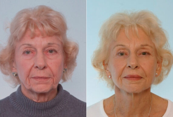 Facelift before and after photos in Houston, TX, Patient 28309