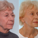 Facelift before and after photos in Houston, TX, Patient 28309