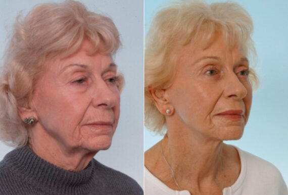 Facelift before and after photos in Houston, TX, Patient 28309