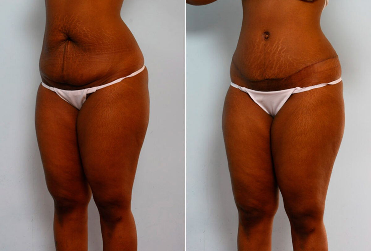 Abdominoplasty before and after photos in Houston, TX, Patient 24232