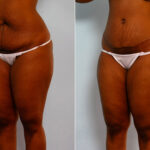 Abdominoplasty before and after photos in Houston, TX, Patient 24232