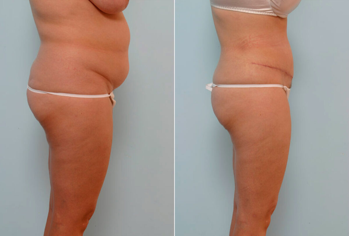 Abdominoplasty before and after photos in Houston, TX, Patient 24608