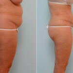 Abdominoplasty before and after photos in Houston, TX, Patient 24608