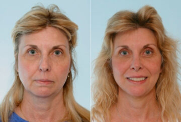 Facelift before and after photos in Houston, TX, Patient 28321