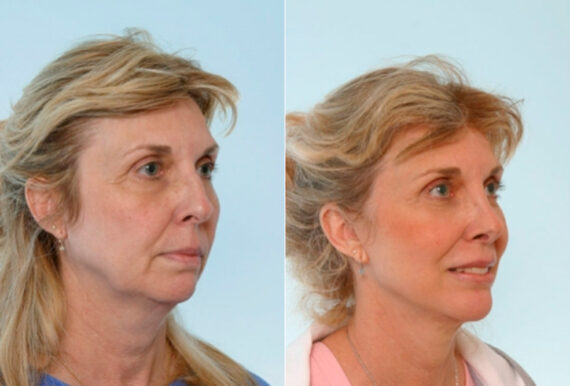 Facelift before and after photos in Houston, TX, Patient 28321