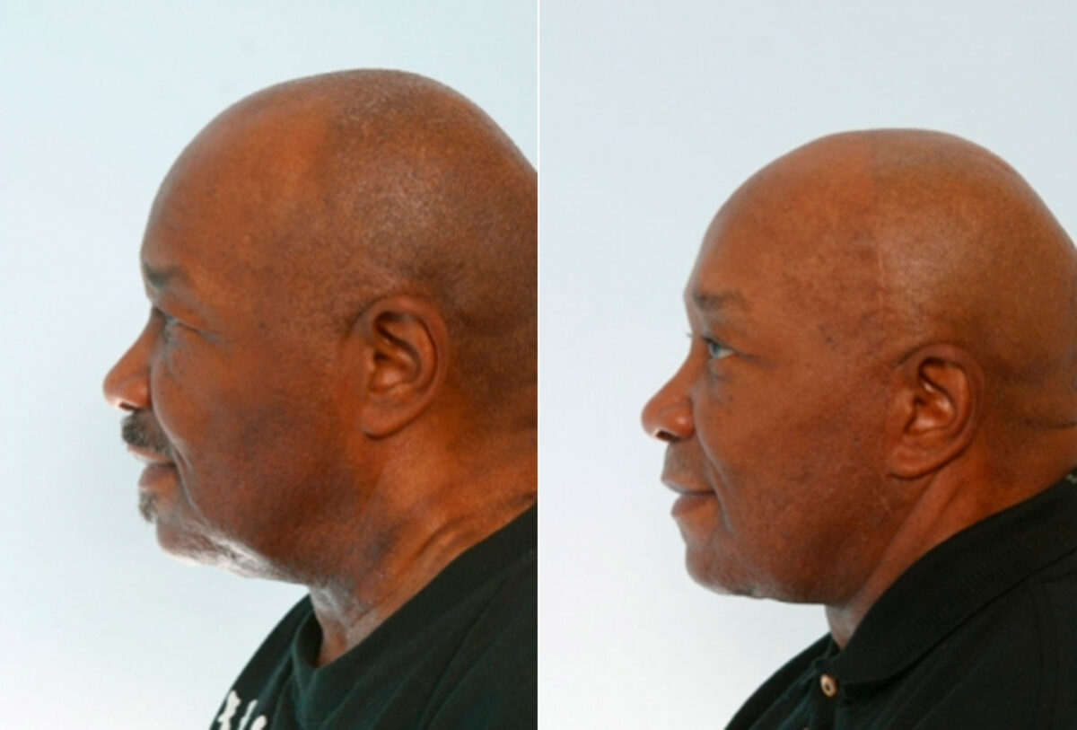 Facelift before and after photos in Houston, TX, Patient 28328