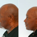 Facelift before and after photos in Houston, TX, Patient 28328