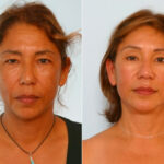 Facelift before and after photos in Houston, TX, Patient 28338