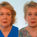 Facelift before and after photos in Houston, TX, Patient 28341