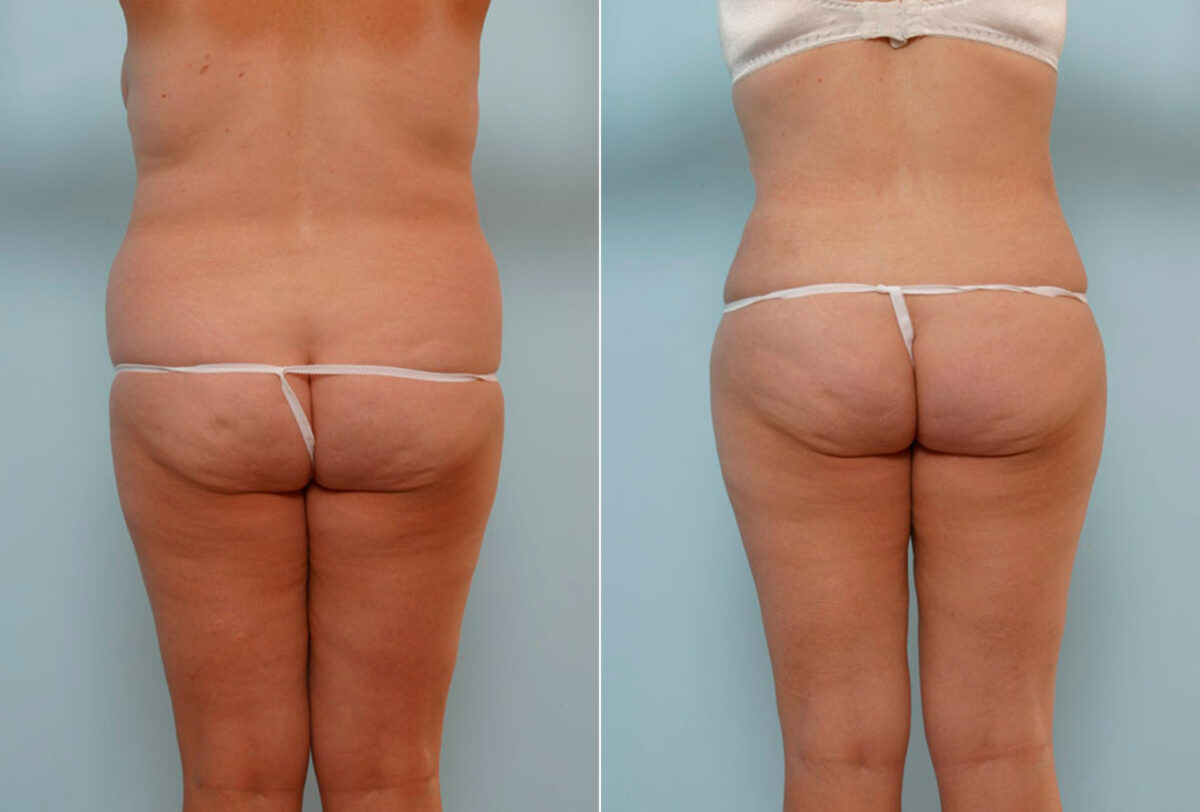 Abdominoplasty before and after photos in Houston, TX, Patient 24608