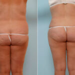 Abdominoplasty before and after photos in Houston, TX, Patient 24608