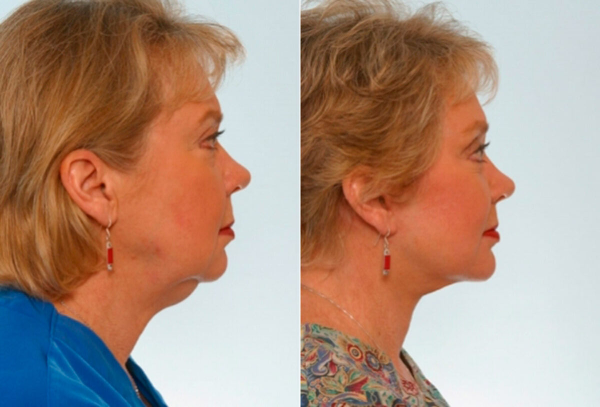 Facelift before and after photos in Houston, TX, Patient 28341