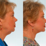 Facelift before and after photos in Houston, TX, Patient 28341