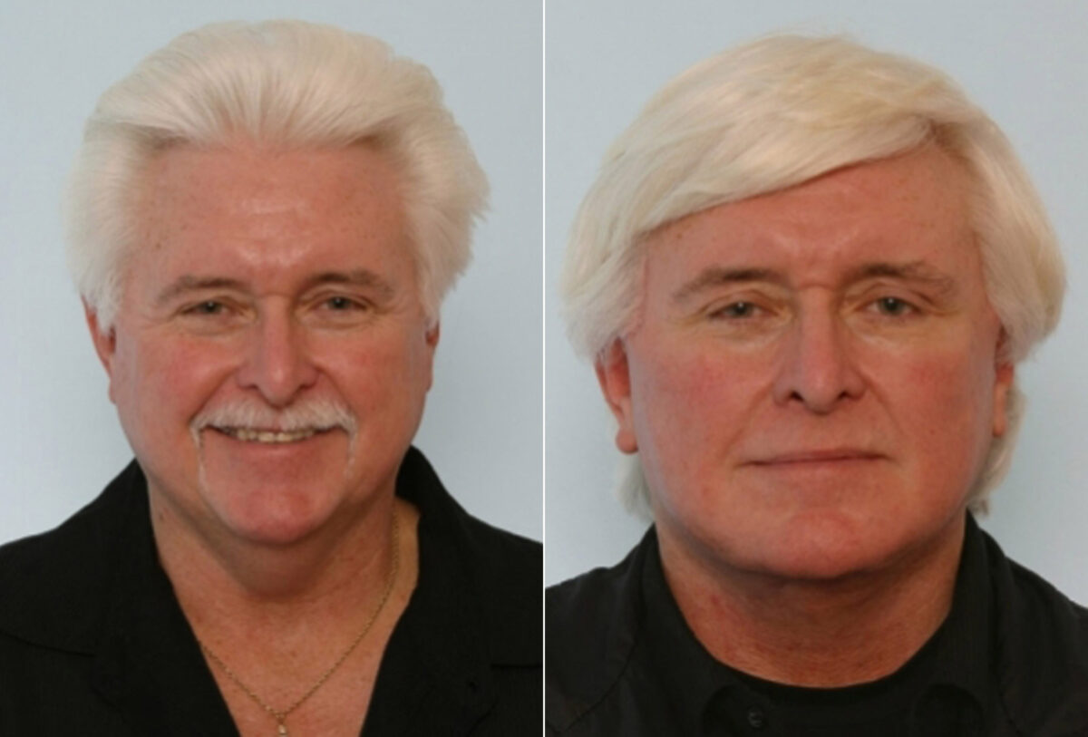 Facelift before and after photos in Houston, TX, Patient 28355