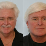 Facelift before and after photos in Houston, TX, Patient 28355