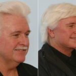 Facelift before and after photos in Houston, TX, Patient 28355