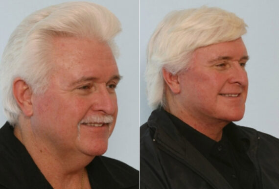 Facelift before and after photos in Houston, TX, Patient 28355