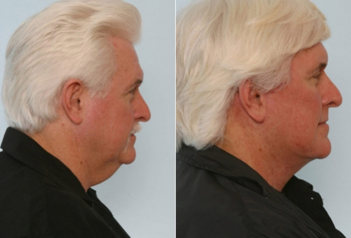 Facelift before and after photos in Houston, TX, Patient 28355