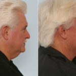 Facelift before and after photos in Houston, TX, Patient 28355