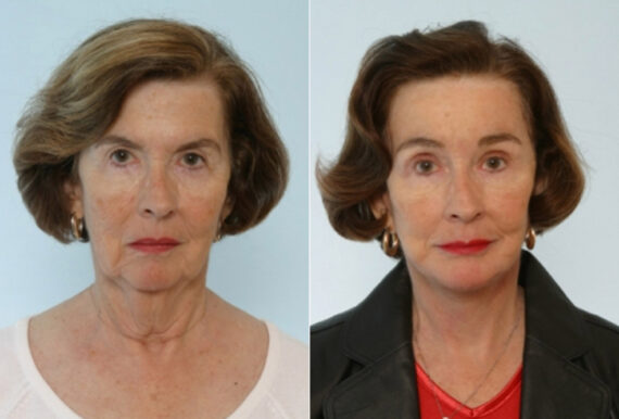 Facelift before and after photos in Houston, TX, Patient 28362