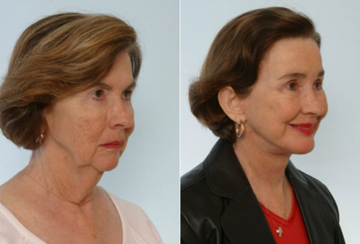 Facelift before and after photos in Houston, TX, Patient 28362