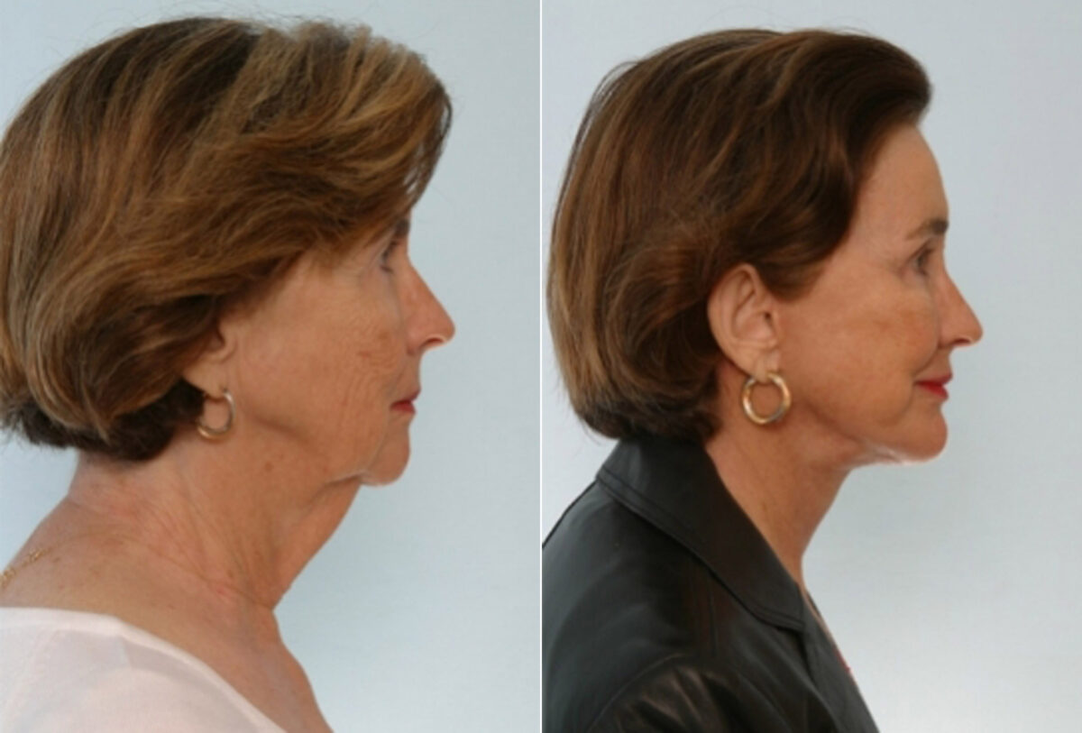 Facelift before and after photos in Houston, TX, Patient 28362