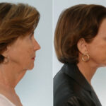 Facelift before and after photos in Houston, TX, Patient 28362