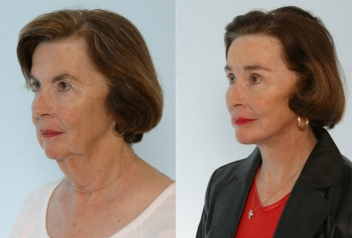 Facelift before and after photos in Houston, TX, Patient 28362