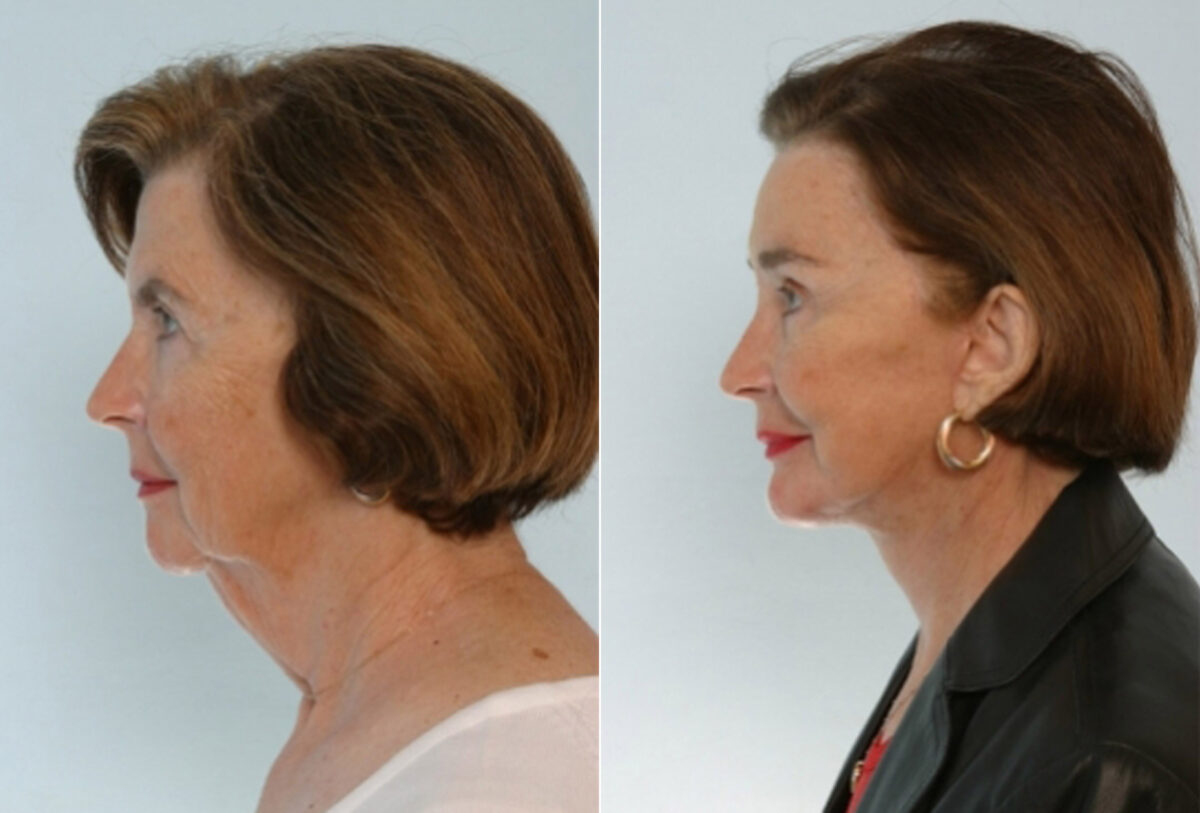 Facelift before and after photos in Houston, TX, Patient 28362