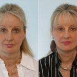 Facelift before and after photos in Houston, TX, Patient 28373