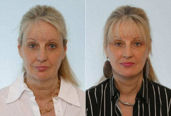 Facelift before and after photos in Houston, TX, Patient 28373