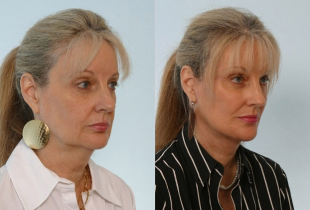 Facelift before and after photos in Houston, TX, Patient 28373