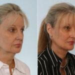 Facelift before and after photos in Houston, TX, Patient 28373