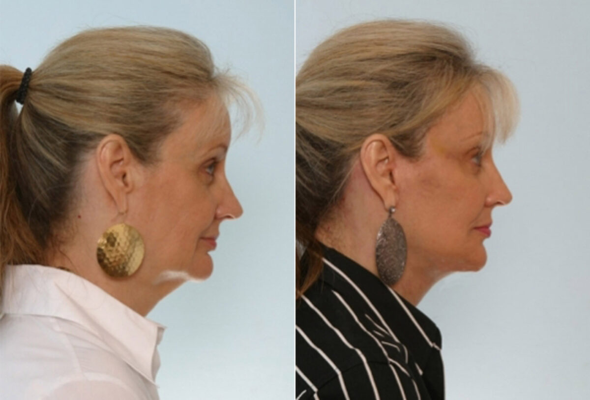 Facelift before and after photos in Houston, TX, Patient 28373