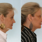 Facelift before and after photos in Houston, TX, Patient 28373