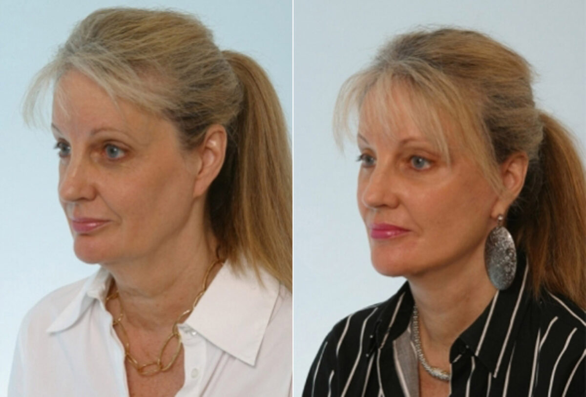 Facelift before and after photos in Houston, TX, Patient 28373