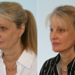 Facelift before and after photos in Houston, TX, Patient 28373