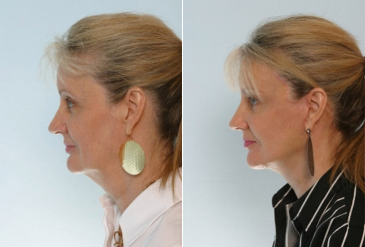 Facelift before and after photos in Houston, TX, Patient 28373