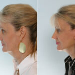 Facelift before and after photos in Houston, TX, Patient 28373