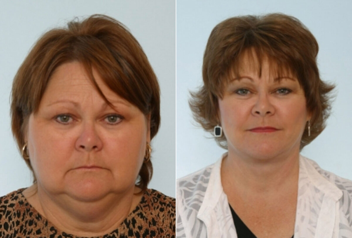 Facelift before and after photos in Houston, TX, Patient 28384